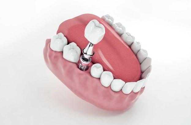 Імплантація зубів: плюси і мінуси процедури